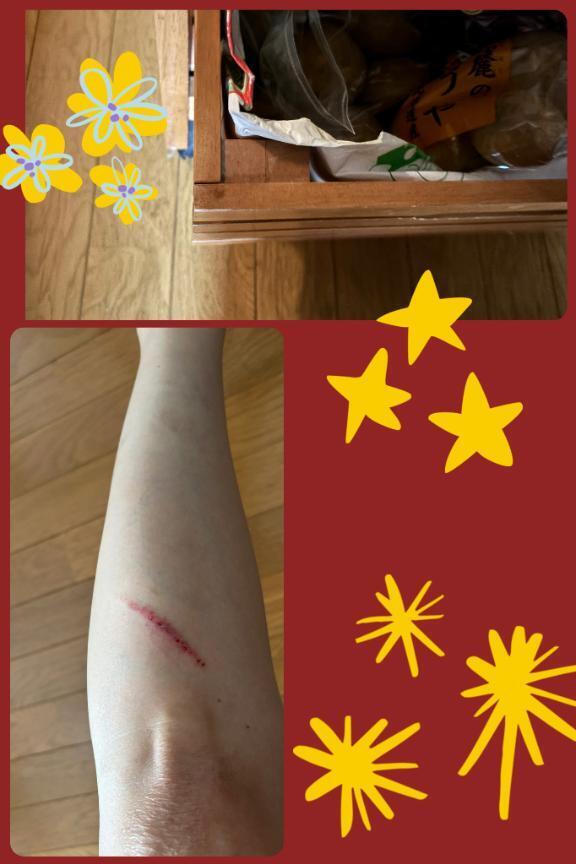 擦りむいた(泣)｜写メ日記｜じゅん｜鶯谷 人妻デリヘル 熟女デリヘル倶楽部