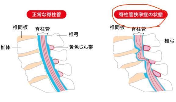 脊柱管狭窄症で腰が激痛😖｜写メ日記｜ひめ｜新宿 人妻デリヘル 熟女の風俗最終章 新宿店