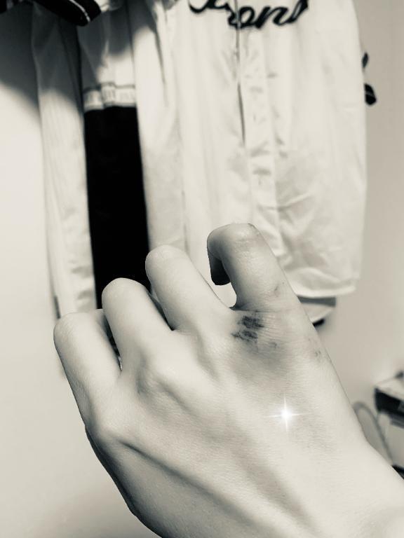 受傷中だったりします🤕｜写メ日記｜桜咲ゆきの｜品川・五反田 一般デリヘル 五反田発　痴漢電車or全裸入室